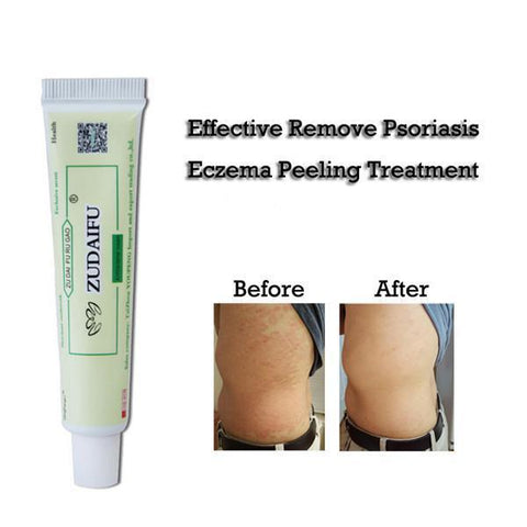 Image of Advanced Psoriasis & Eczema Cream