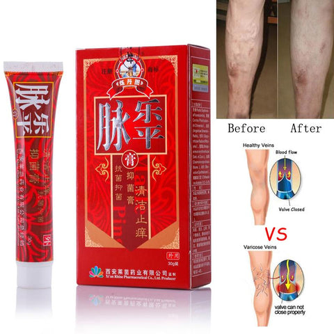 Image of Varicose Veins Treatment Cream